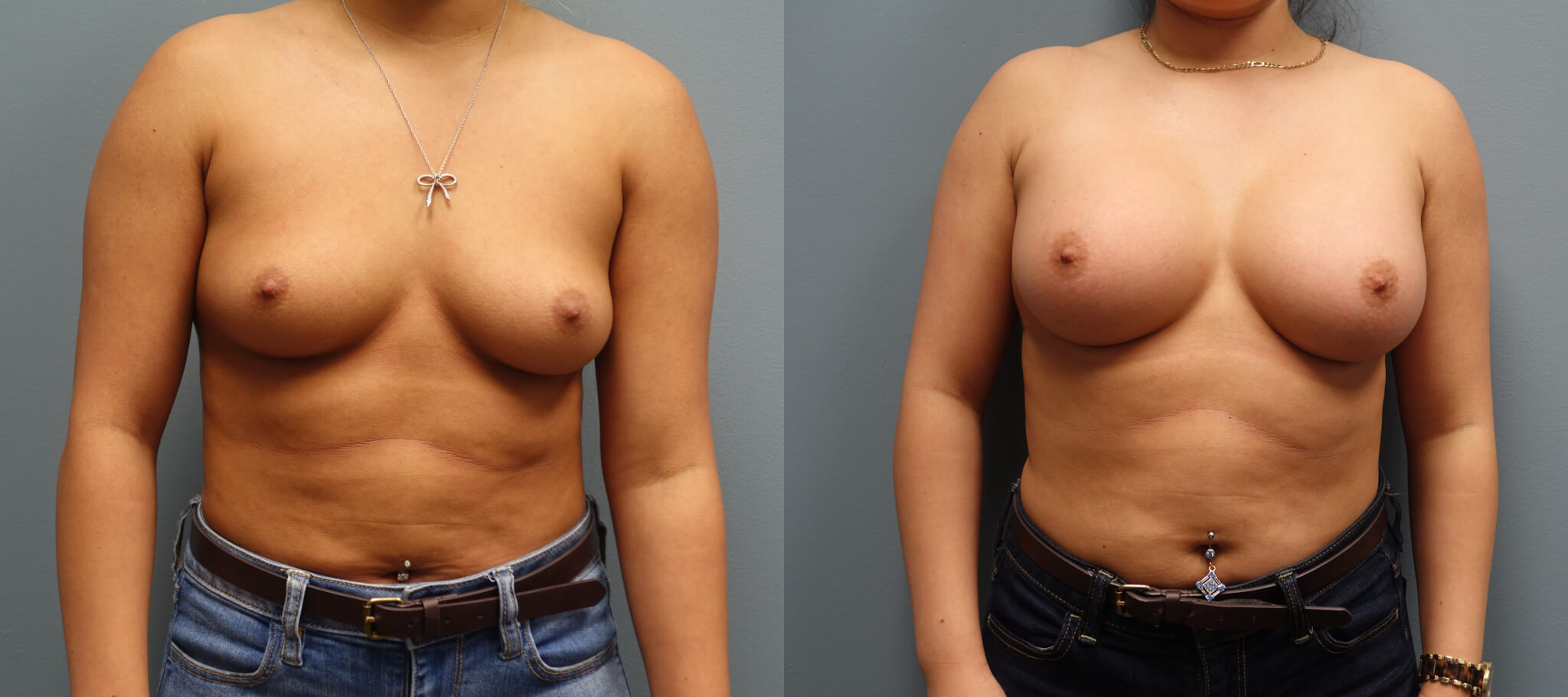Before and after Breast Augmentaion 350CC Silicone Implant