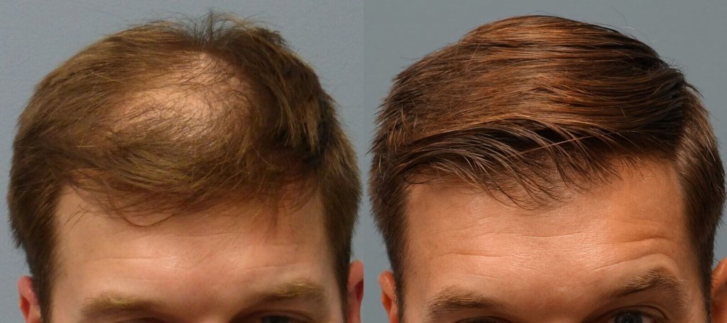 Neograft 34 year old 1,502 Grafts Before and 5 Months post-op