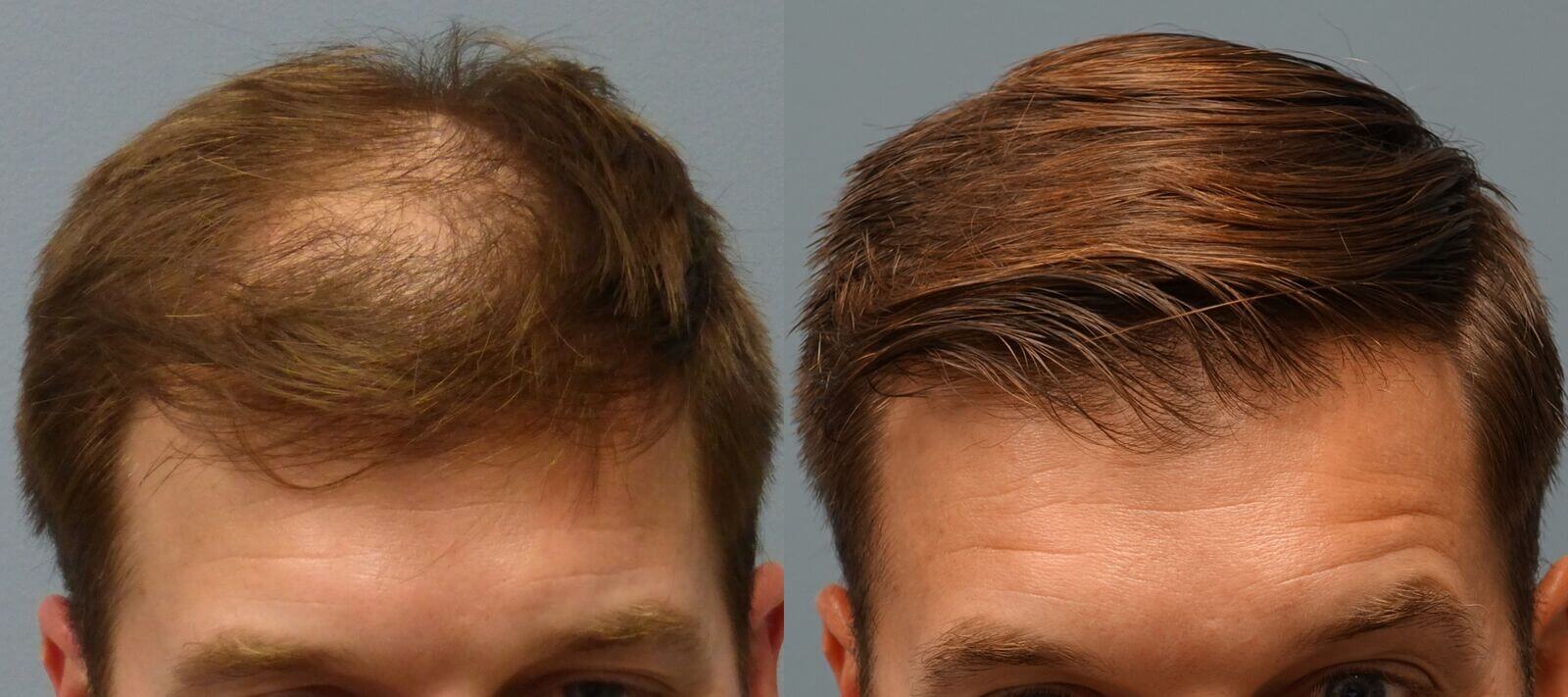 NeoGraft Overview| Hair Restoration Savannah | Dr. E. Ronald Finger