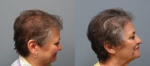 Hair Transplant with strip excision 1,325 Grafts Before and 11 months after