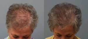 Hair Transplant with strip excision 69 year old 1,325 Grafts Before and 11 months after