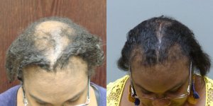 This patient had 2 Transplants and a Scalp Reduction, graft total 4,050 grafts Before and 1 year post-op