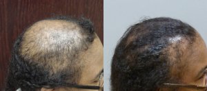 Hair Transplant with strip excision 54 year old This patient had 2 sessions, the final total was 4,050 grafts Before and 1 year post-op