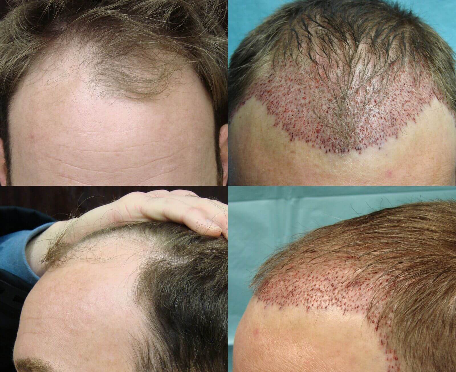 FUE Hair Transplant 1349 Grafts Into Crown - The Maitland Clinic