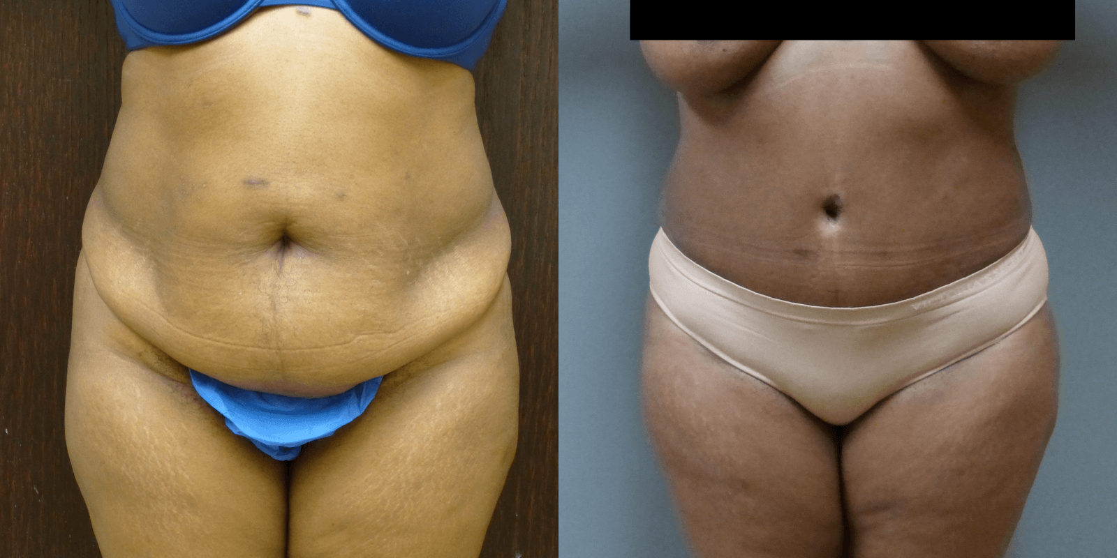 Rapid Recovery Abdominoplasty with liposuction of sides before and 1 year after
