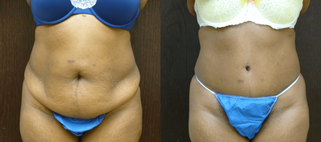 57 year old Abdominoplasty with liposuction of the sides Before and 2 months post-operative. Dr. Finger specializes in the Tummy Tuck procedure without drains.