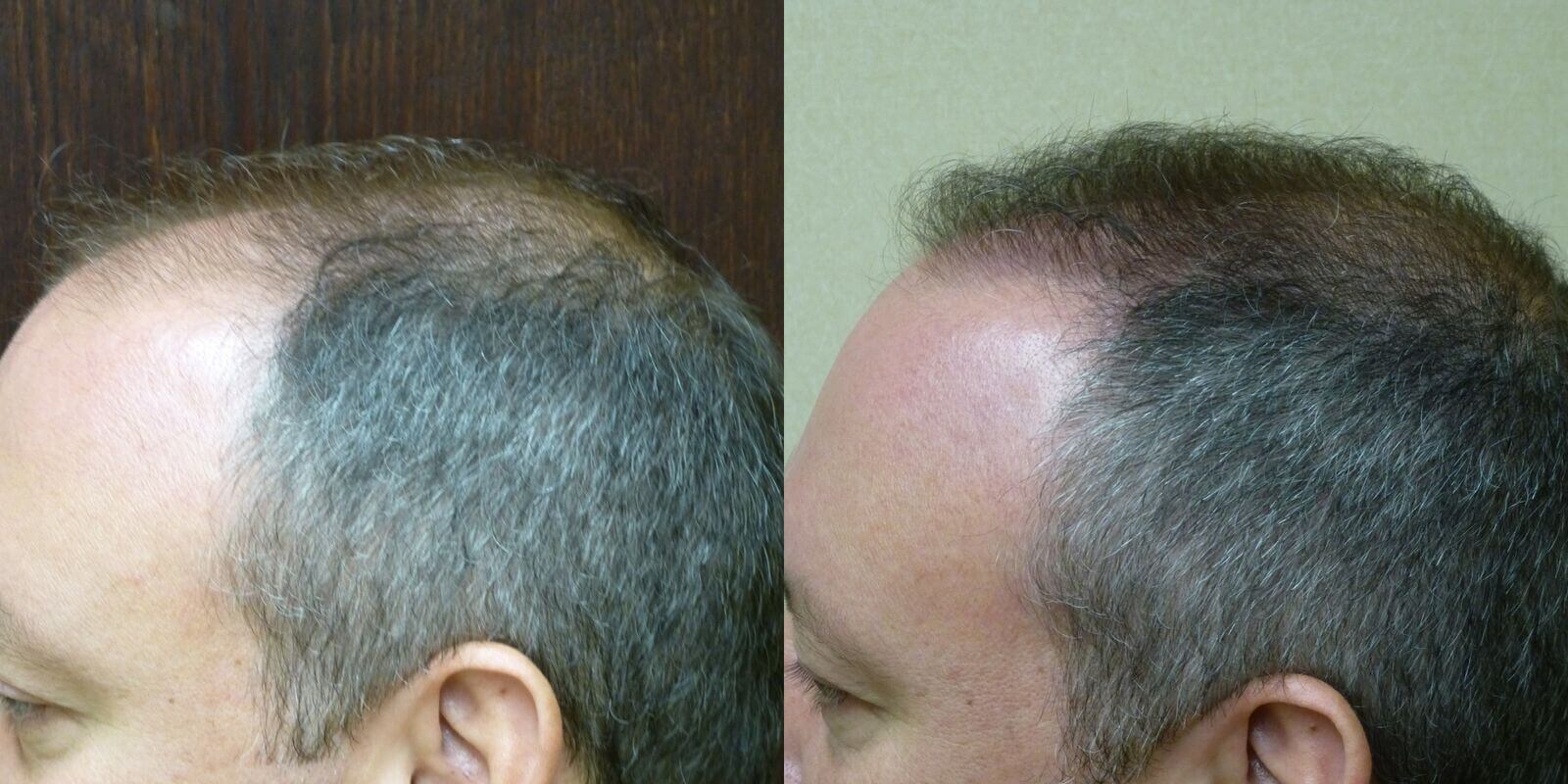 Neograft 43 year old 2,300 grafts to Hairline & crown before and 6 months after