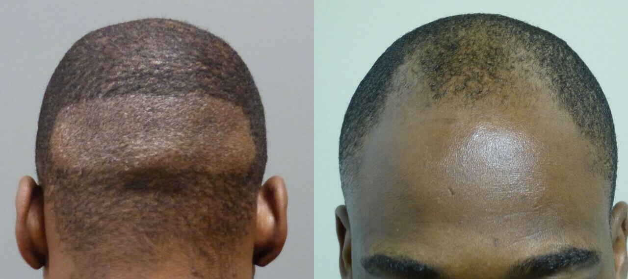 This is an example of a neograft patient, the first set show his donor site and his before picture, the second set shows him 11 days after and then at 4 months after