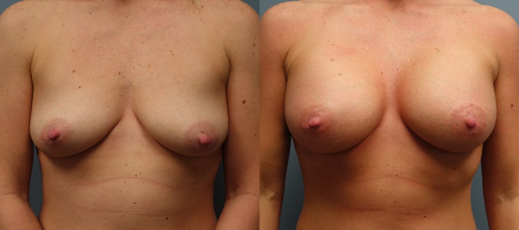 Before & After Silicone implants Right- 450CC Left 425CC Sub Muscular