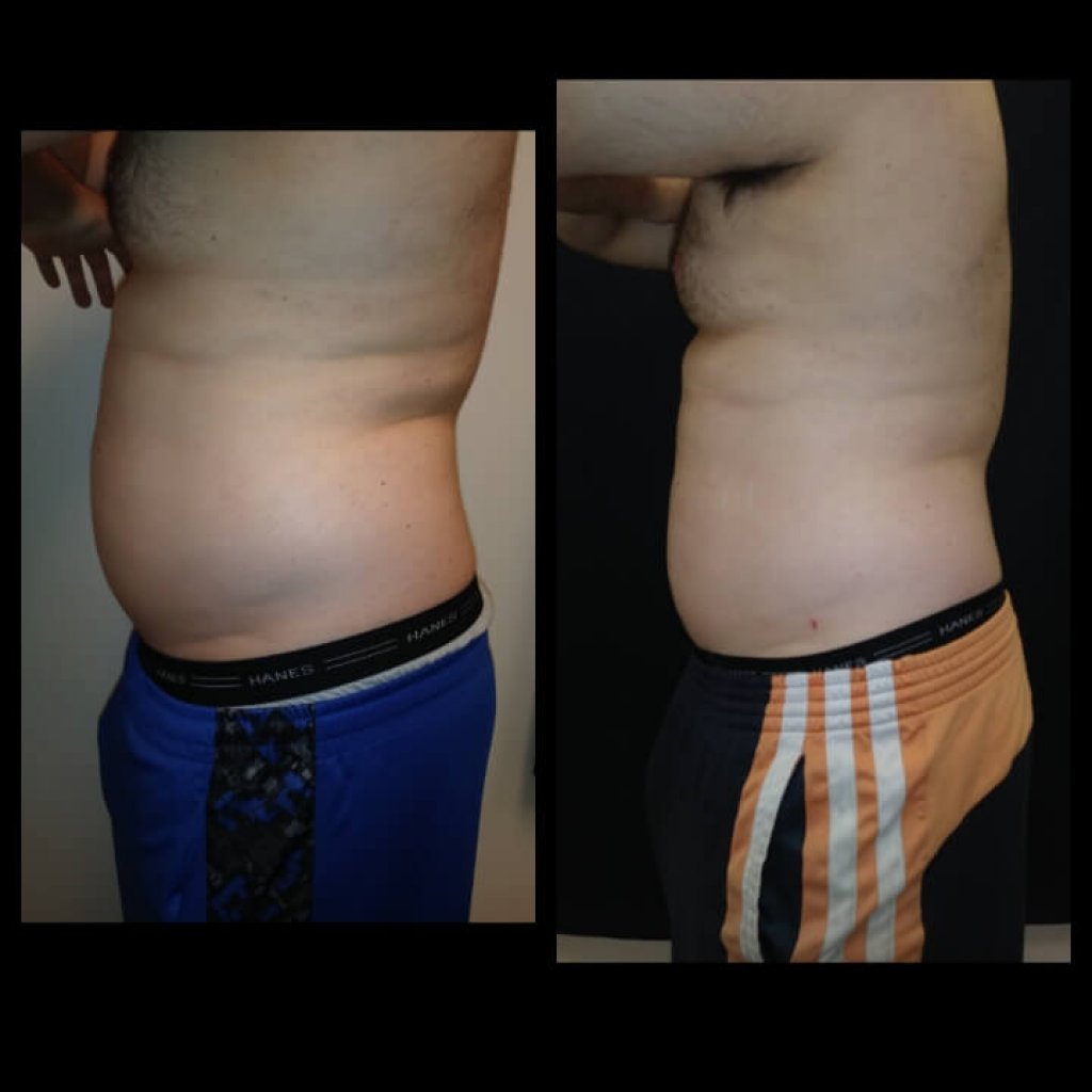 Before and after 2 Posh Body Slim Treatments Treatment