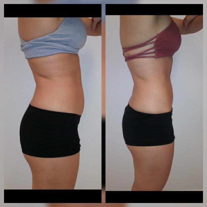 Before and after 2 Posh Body Slim Treatments – Treatment Goal Fat Reduction & Skin Tightening