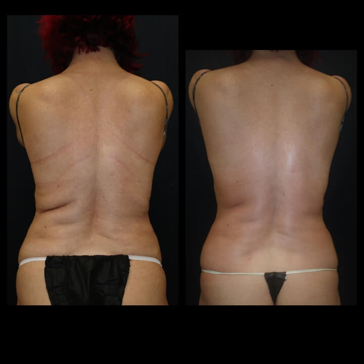 Before and after 2 Posh Body Slim Treatments - Treatment Goal Fat Reduction and Skin Tightening