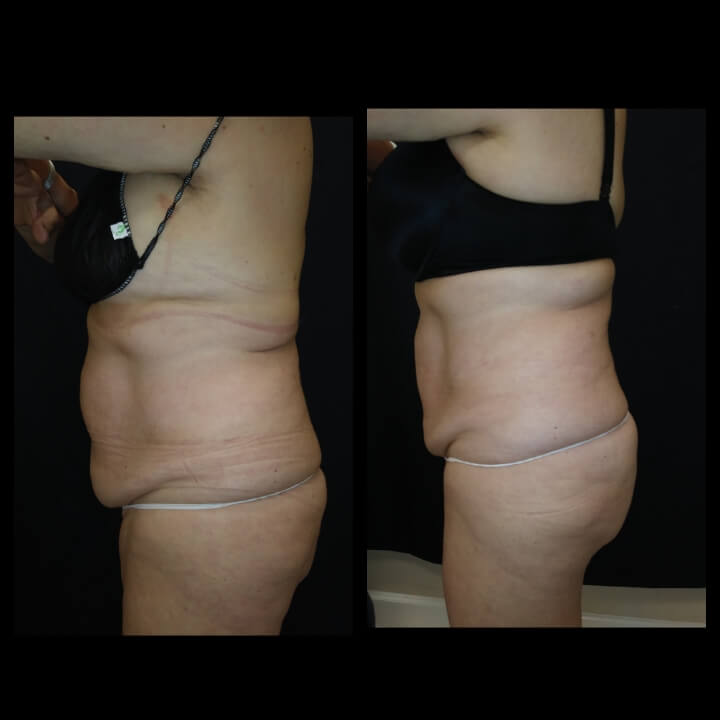 Before and After 2 Posh Body Slim Treatments - Treatment Goal Fat Reduction & Skin Tightening