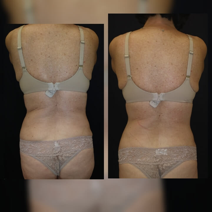 Before and After One Posh Body Slim Treatment - Treatment Goal Fat Reduction & Skin Tightening
