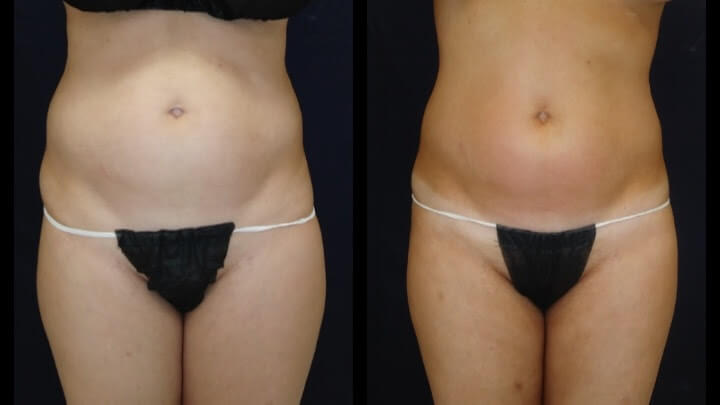 Before and after 2 Posh Body Slim Body Contouring Sessions - Treatment Goal Fat Reduction & Skin Tightening