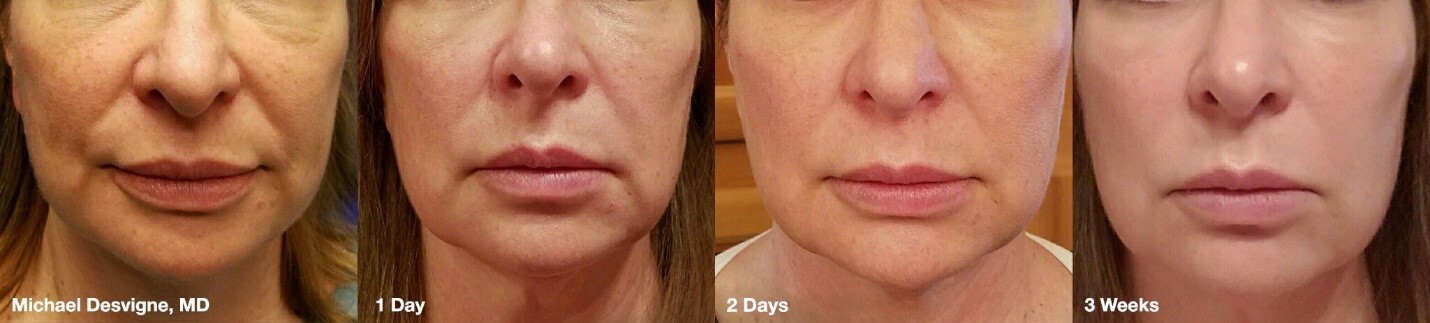 SilhouetteInstalift Results- The Nonsurgical Facelift. Finger and Associates in Savannah, Georgia 