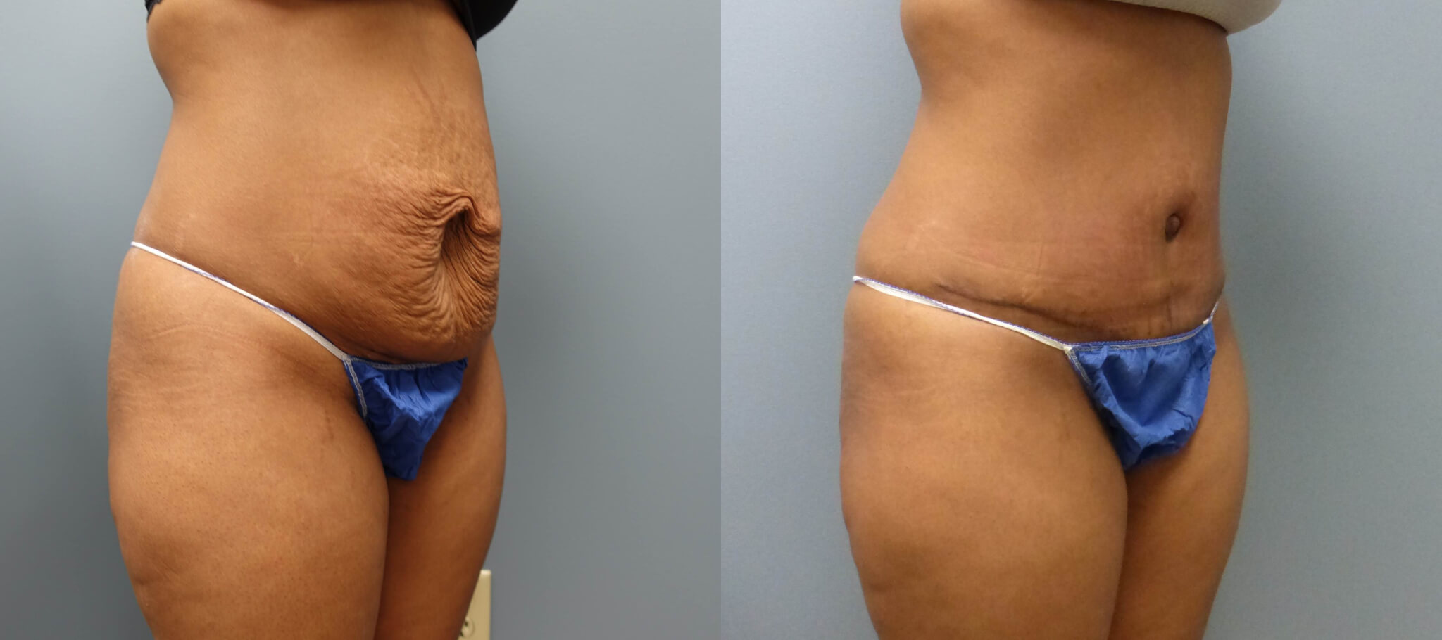 This patient had a  Tummy Tuck without drains and Liposuction by Dr. E. Ronald Finger  