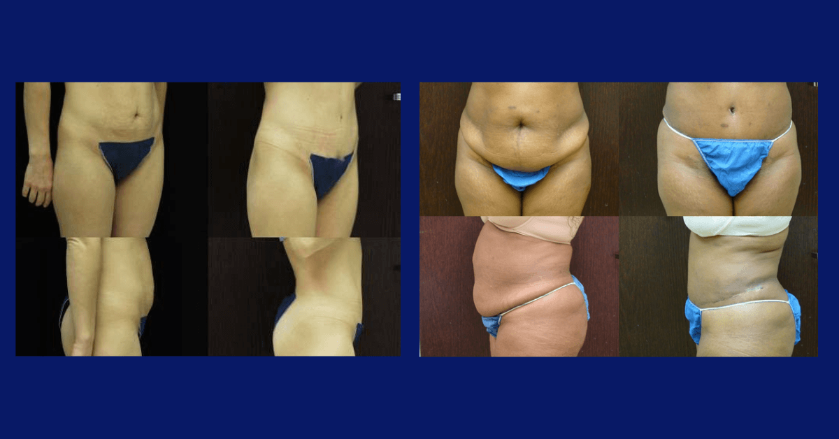 Tummy Tuck Methods and Renuvion fro Skin Tightening