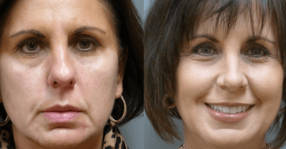 Nose Job by Dr. Finger- Savannah Rhinoplasty- Skilled Surgeon