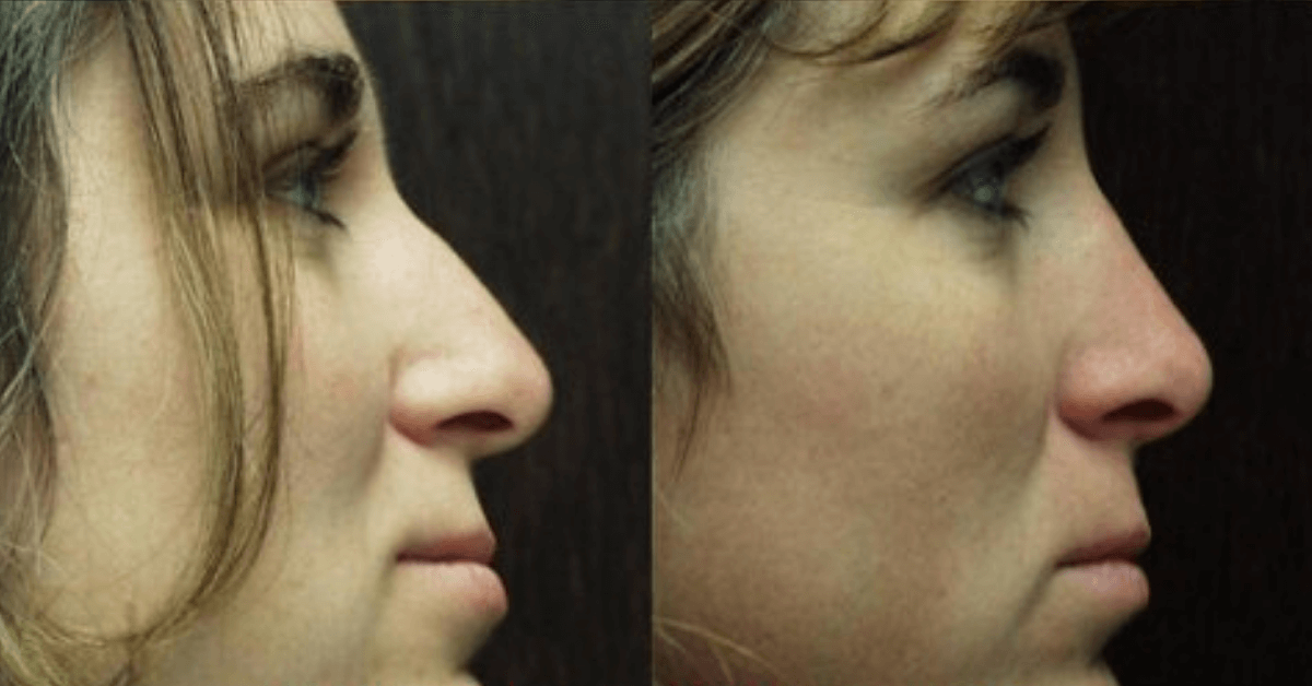 Nose Job by Dr. Finger- Savannah Rhinoplasty- Skilled Surgeon