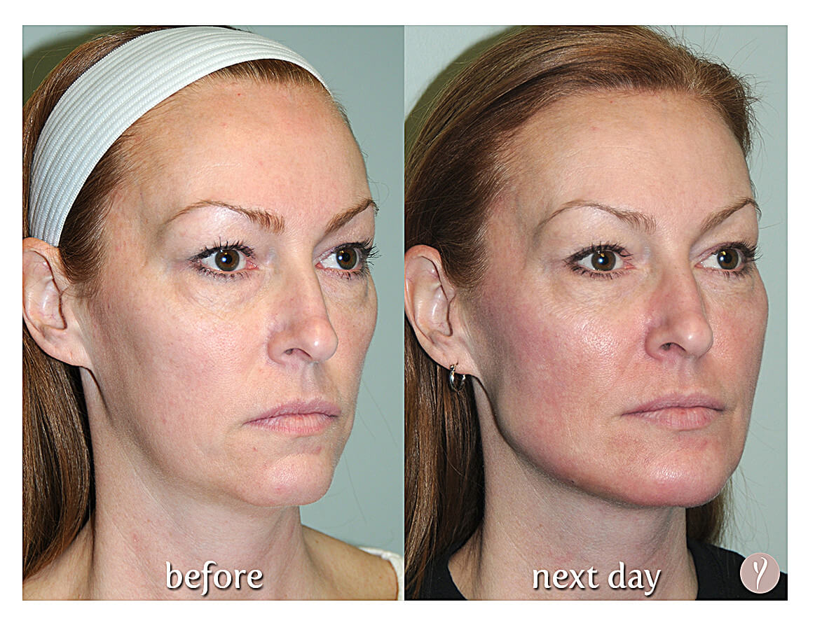 Experience The Latest Nonsurgical Facelift The Y Lift - Savannah, Georgia- by Dr. Finger