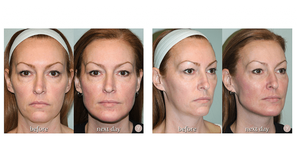 Experience The Latest Nonsurgical Facelift The Y Lift - Savannah, Georgia- by Dr. Finger 