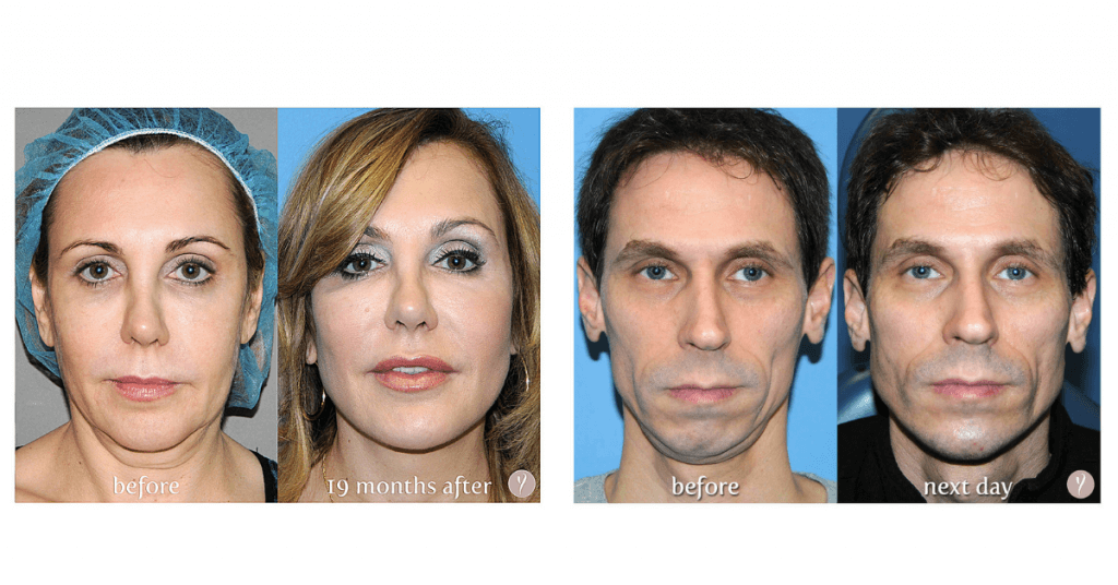 experience-the-latest-nonsurgical-facelift-the-y-lift-savannah-georgia-by-dr.-finger-