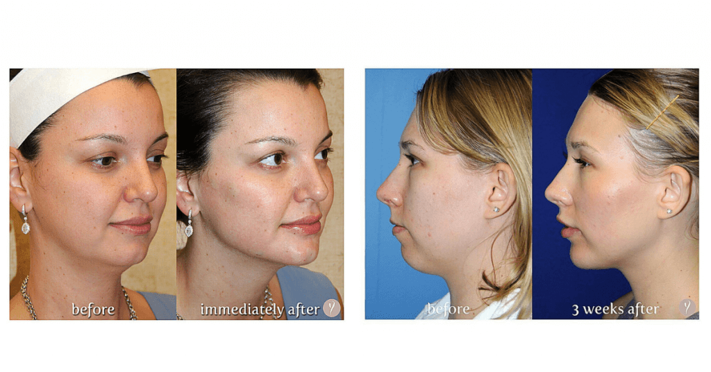 experience-the-latest-nonsurgical-facelift-the-y-lift-savannah-georgia-by-dr.-finger-1