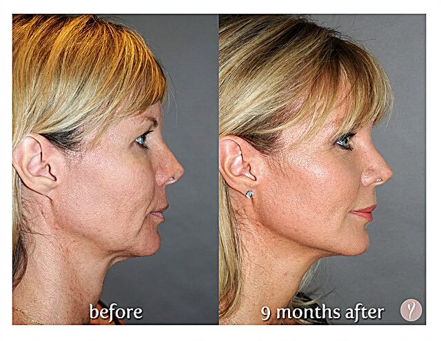 experience-the-latest-nonsurgical-facelift-the-y-lift-savannah-georgia-by-dr.-finger-2