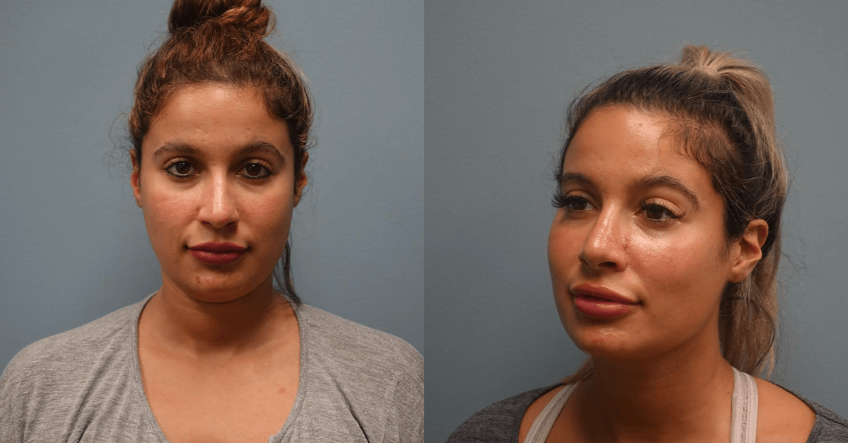 Before and After secondary Rhinoplasty with cartilage repair.