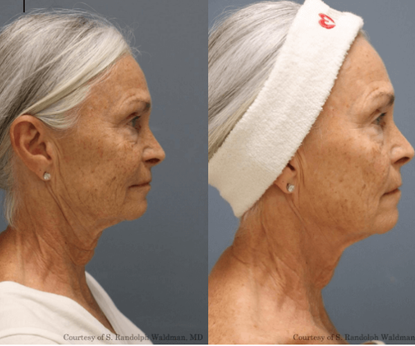 Pixel8-RF Micro-Needling for skin rejuvenation Pixel8 Microneedling RF