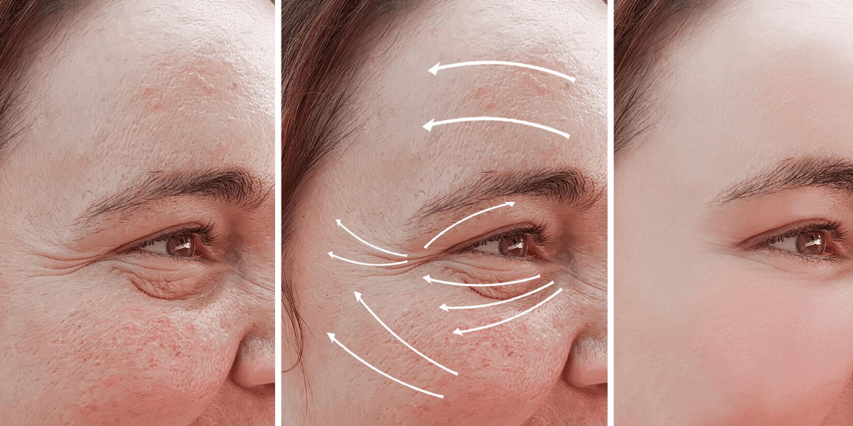 pixel8-rf-micro-needling-skin-rejuvenation-meets-radiofrequency-for-skin-tightening-finger-and-associates-in-savannah-georgia-1