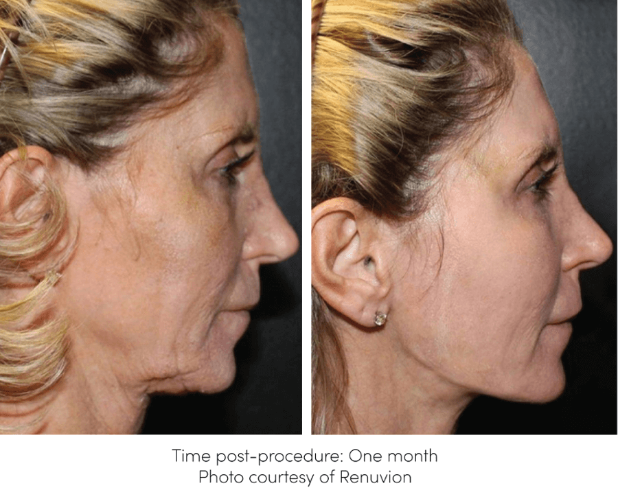 Renuvion for Skin-Tightening Before and After Picture of patient neck and lower face