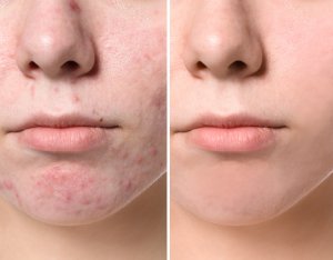 acne and acne scarring can be treated with the Pixel 8