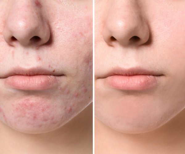 Young woman before and after acne treatment, closeup. Skin care concept acne and acne scarring can be treated with the Pixel 8