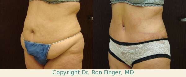 Tummy Tuck and Skin Tightening Treatments it FInger and Associates