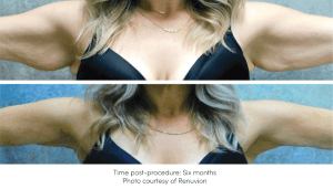 Before and After Renuvion Skin Tightening Treatment offered at Finger and Associates