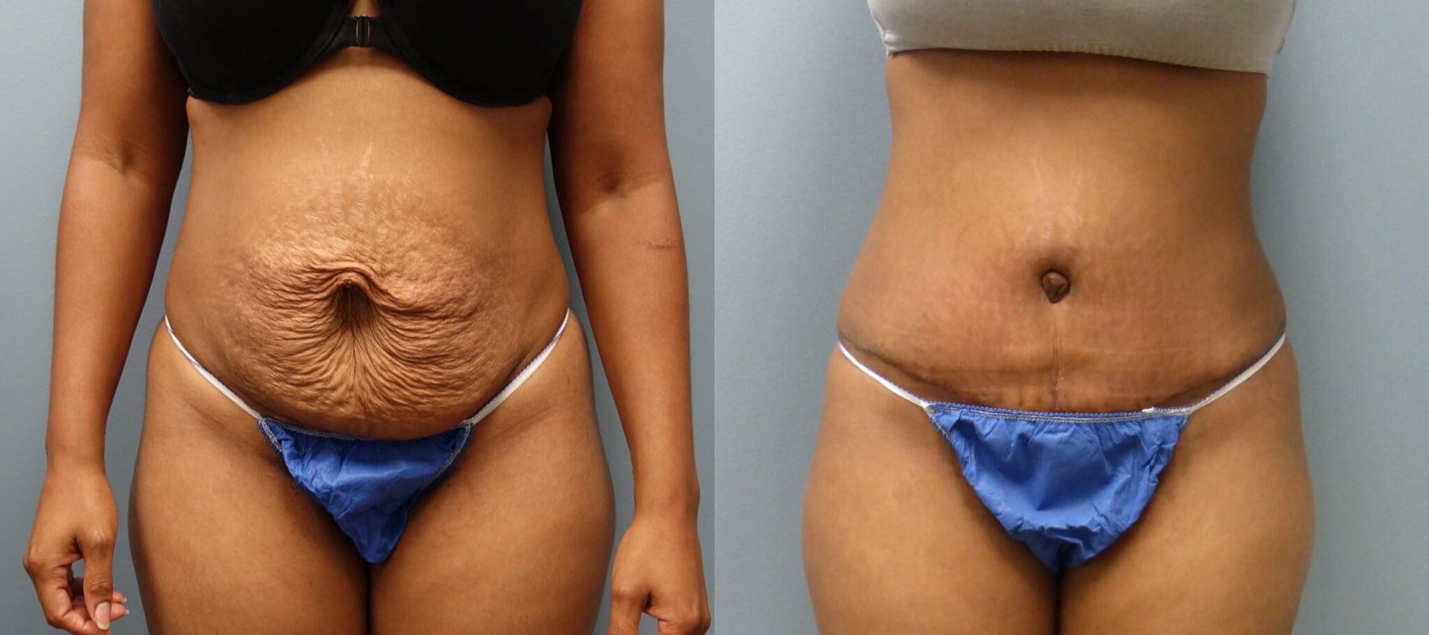 Six weeks after an no-drain tummy tuck with rectus muscle repair