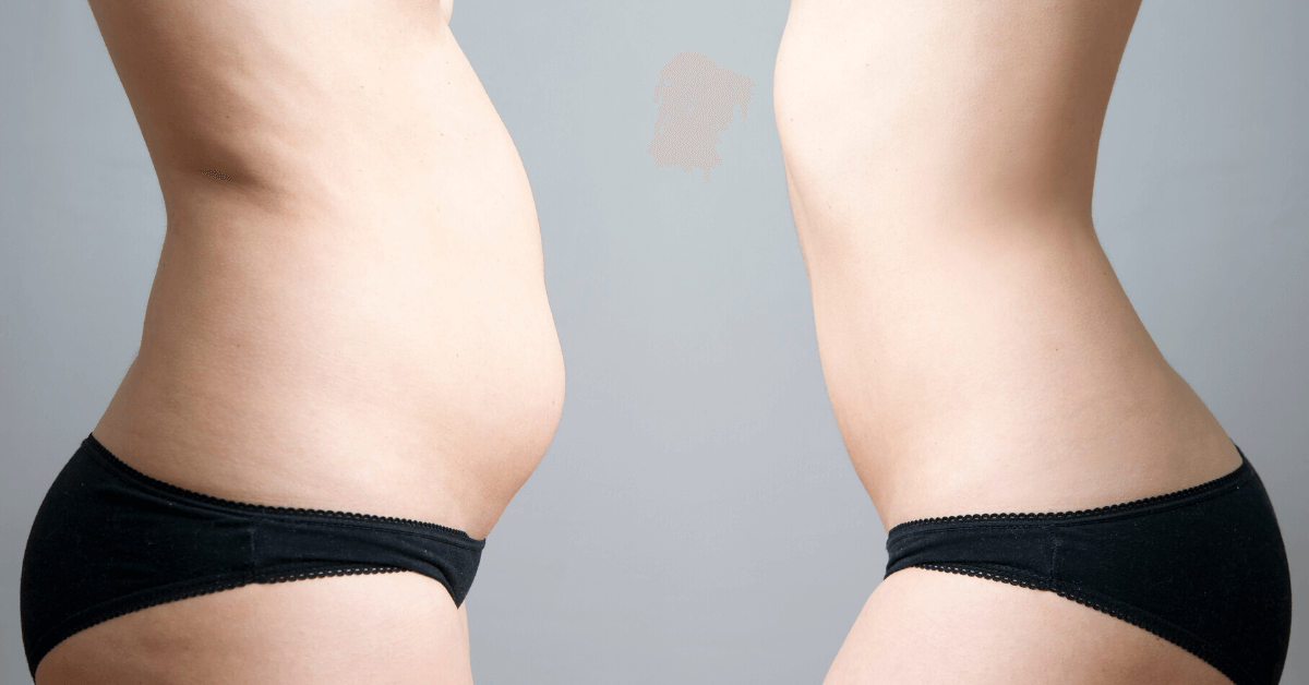 Tummy Tuck and Skin Tightening Treatments it FInger and Associates