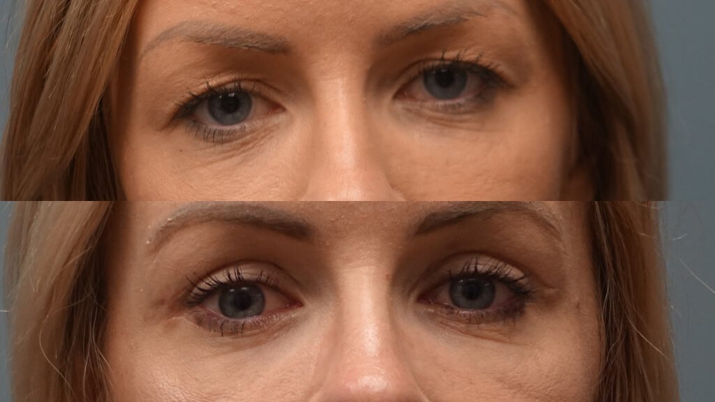 Eyelid Lift Surgery offered at Finger and Associates - Plastic Surgeon Dr. Finger offers Blepharoplasty in Savannah in Bluffton 