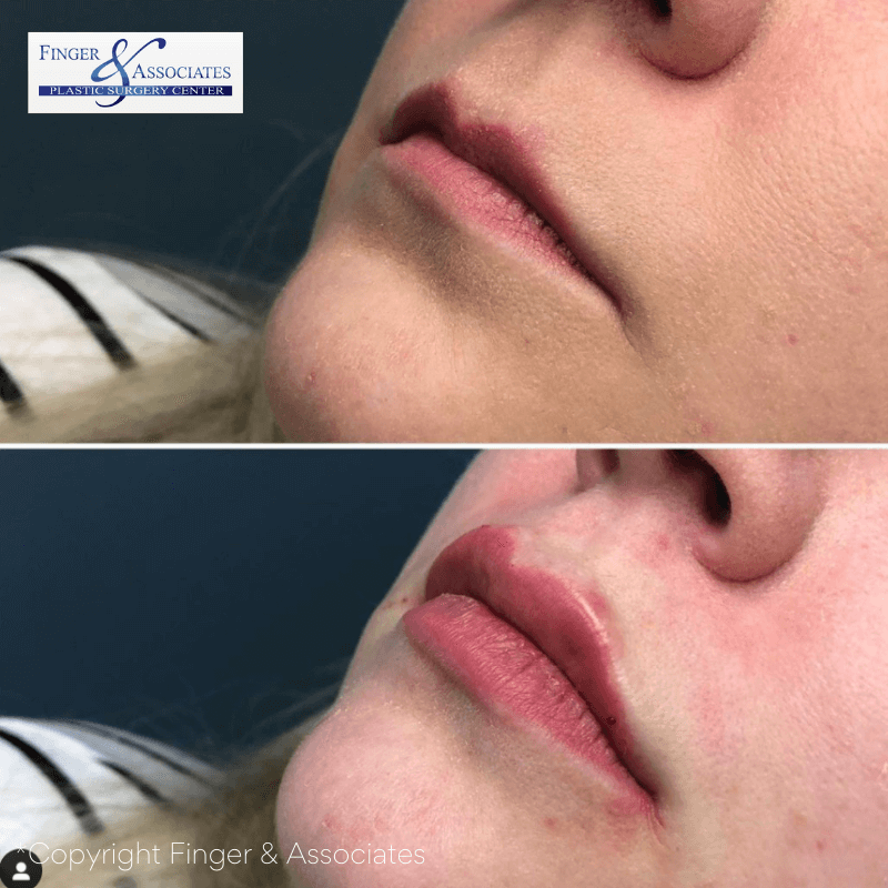 Before and After Restylane Kysse Lip Filler offered at FInger and Associates