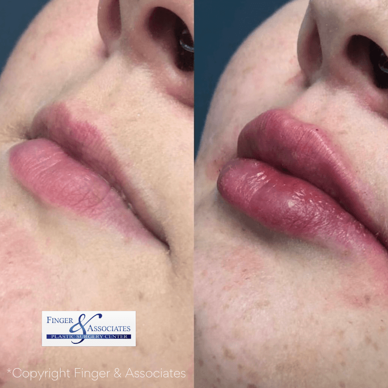 Before and After Restylane Kysse Lip Filler offered at FInger and Associates