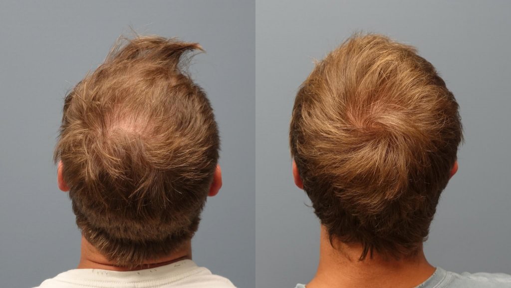 Before and after 1 year Neograft Hair Transplant 2500 Grafts