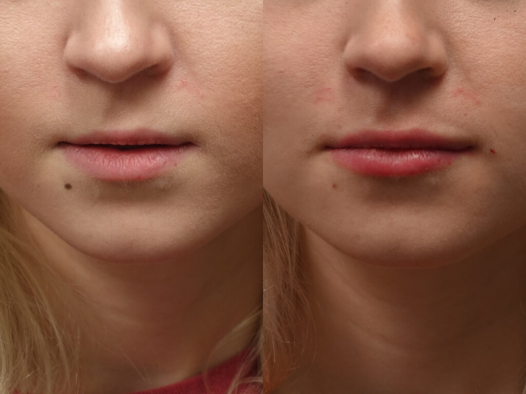 Before and after one Syringe of Vollure to create subtle results and add volume - By Dr. E. Ronald Finger