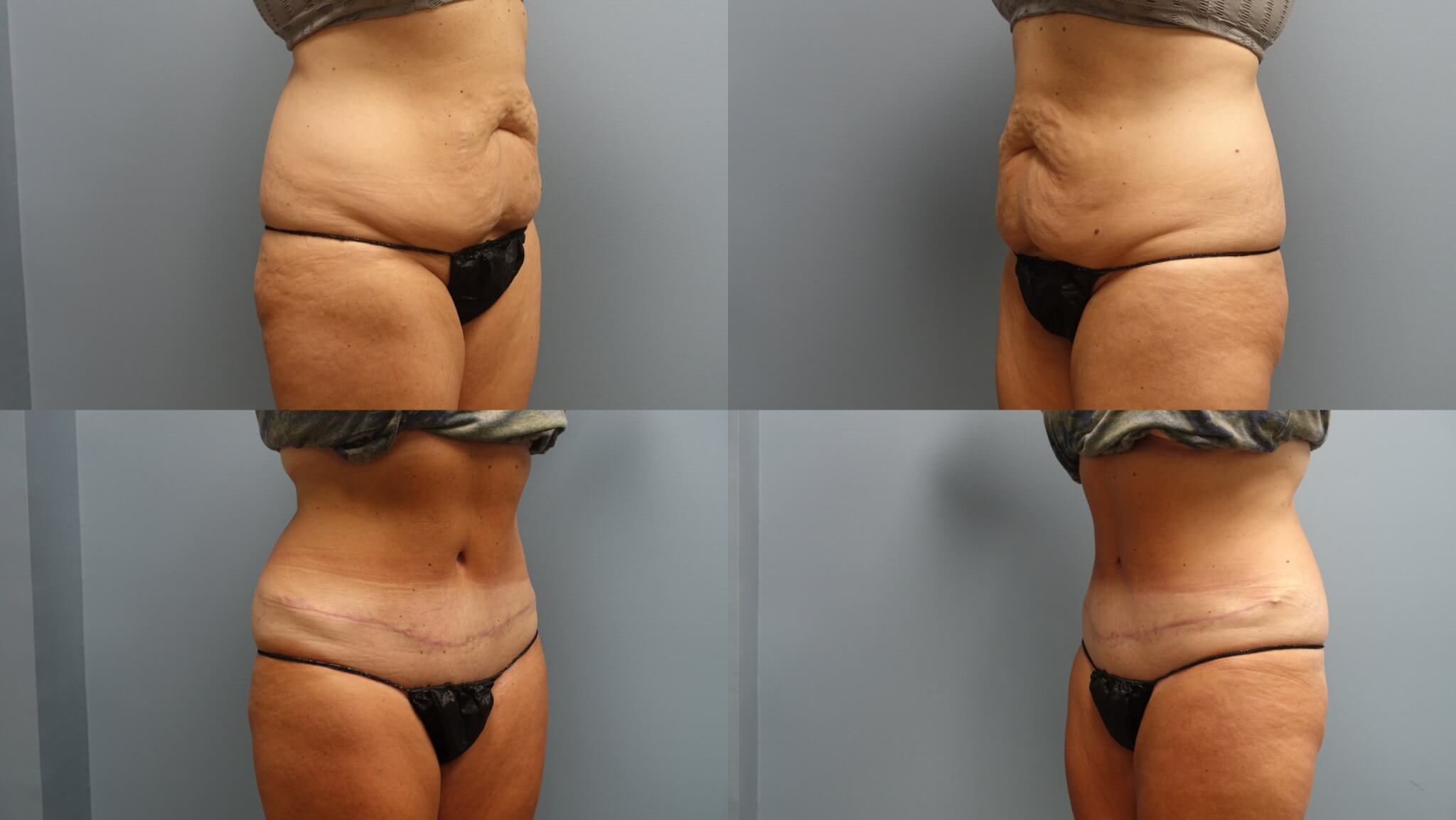 Before and After 4-months of Tummy Tuck by Dr. E. Ronald Finger
