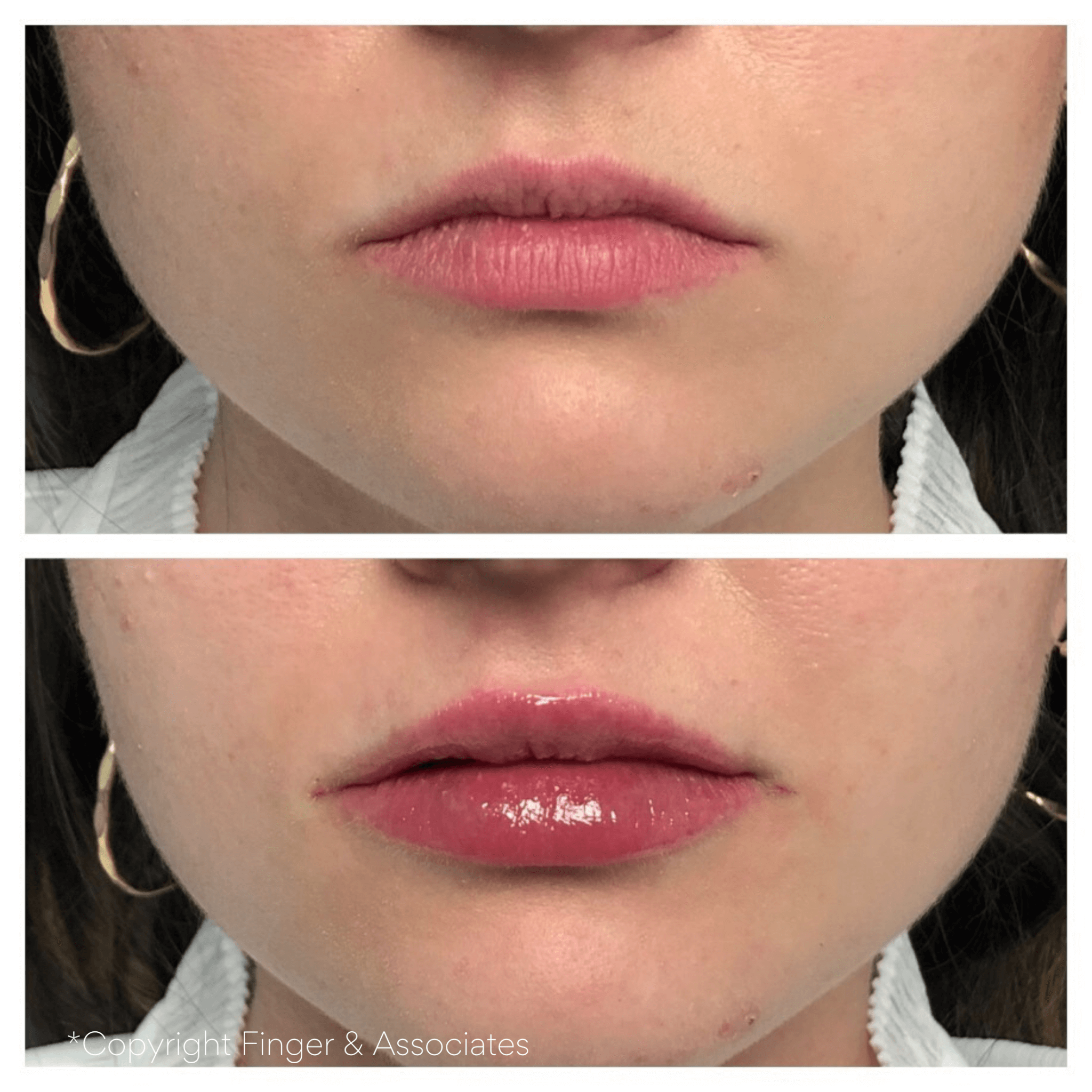 Before and after Lip Filler with Restylane Kysse the latest FDA cleared Filler for 2020.