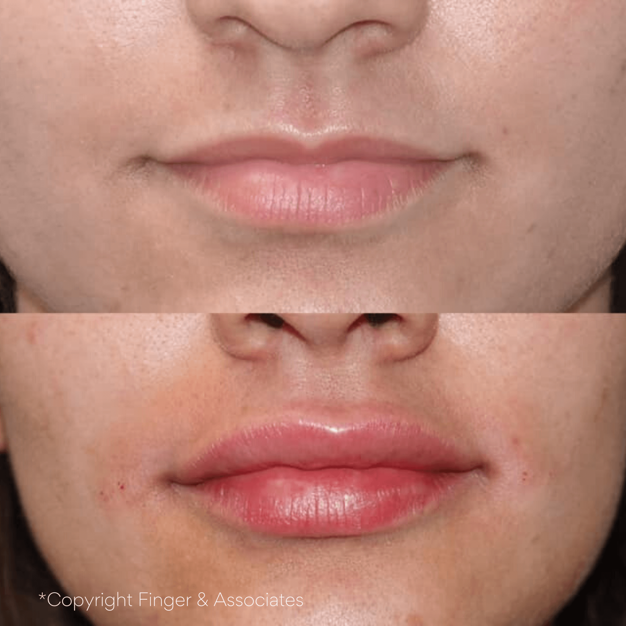 Before and after one syringe of Restylane Kysse - Swelling will subside