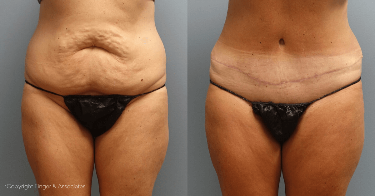 Before and after Tummy Tuck