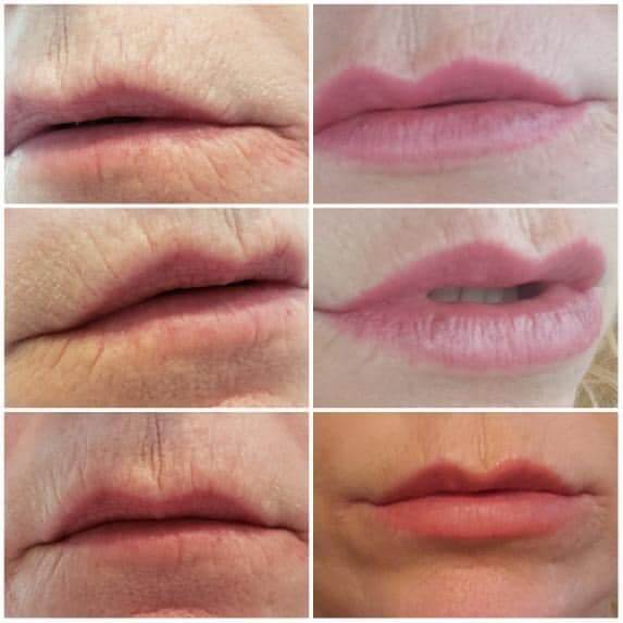 Before and after Restylane Kysse for Lips by E.Ronald Finger