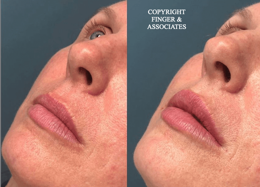 Before and after 1/2 Syringe of Juvederm